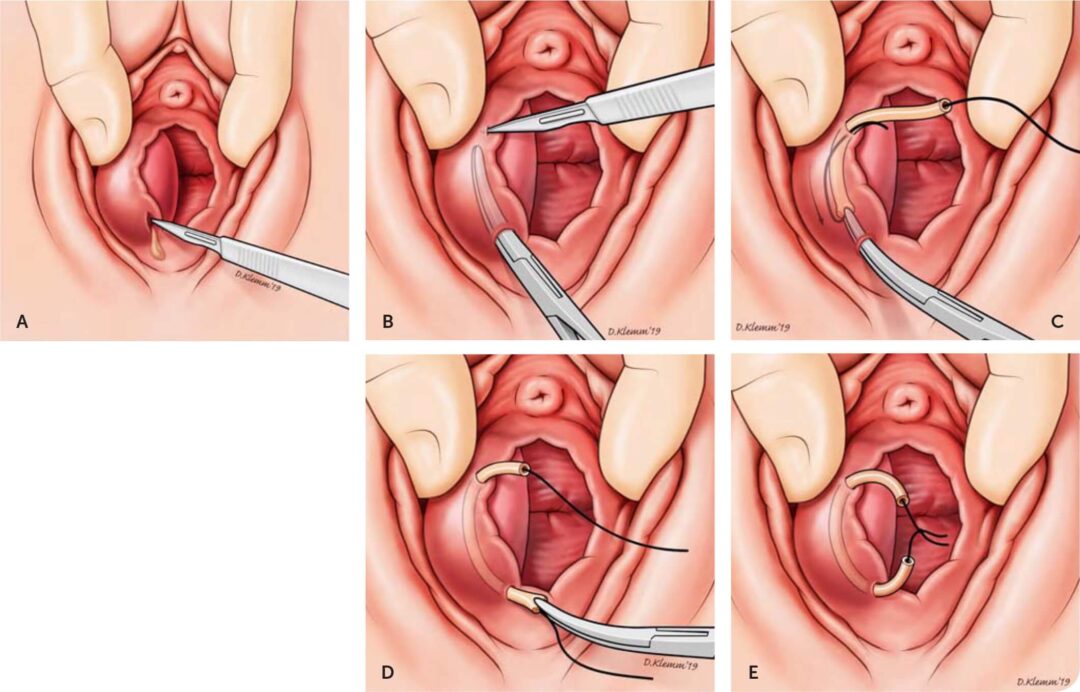 How To Get Rid Of Piles Permanently: Guide To Long Relief