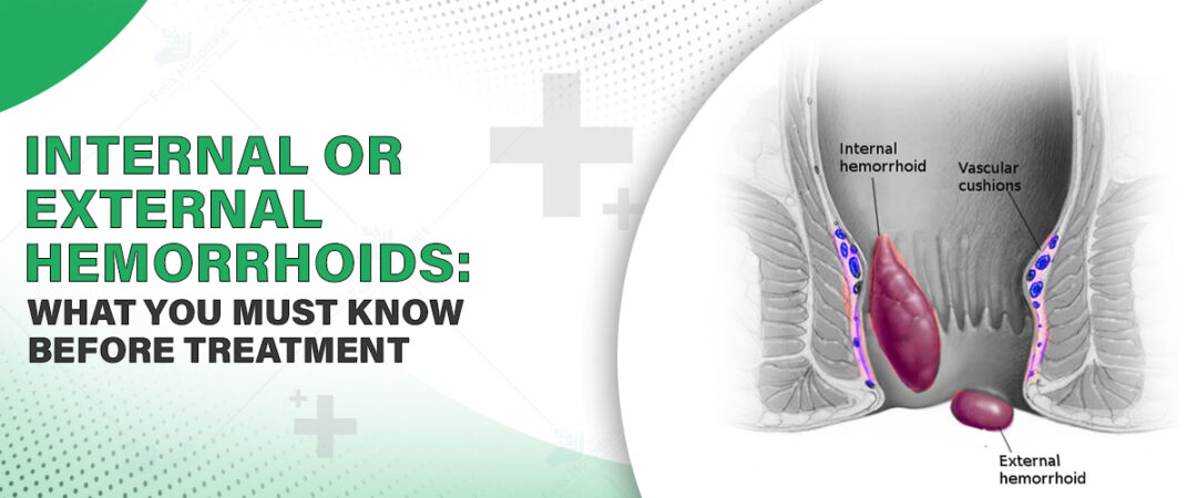 Non Inflamed Pile Internal And External Piles: Understanding The Difference