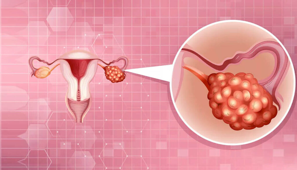 What Size Ovarian Cyst Needs Surgery