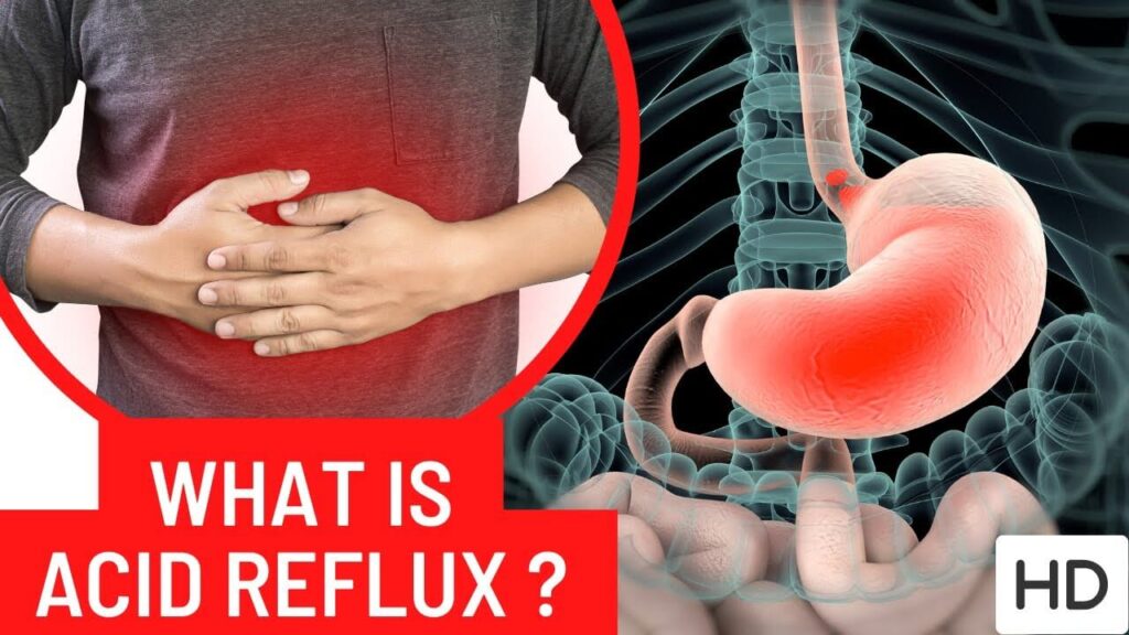 What Is Acid Reflux, Its Symptoms, Treatments, and Natural Remedies for Adults 6 How Acid Reflux Affects the Body